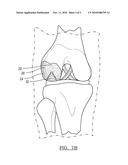 Stable Cartilage Defect Repair Plug diagram and image