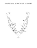 BIOCOMPATIBLE SHELL FOR BONE TREATMENT diagram and image