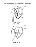 METHODS AND APPARATUS FOR FORMING CARDIAC LESIONS AND ASSESSING LESION QUALITY diagram and image