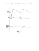 Pulse Detection Method and Apparatus Using Patient Impedance diagram and image