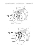 BIOELECTRIC IMPLANT AND METHOD diagram and image