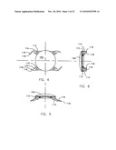 REFRACTIVE INTRAOCULAR IMPLANT LENS AND METHOD diagram and image