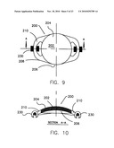 REFRACTIVE INTRAOCULAR IMPLANT LENS AND METHOD diagram and image