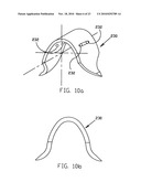 REFRACTIVE INTRAOCULAR IMPLANT LENS AND METHOD diagram and image