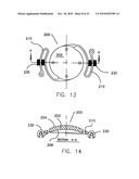 REFRACTIVE INTRAOCULAR IMPLANT LENS AND METHOD diagram and image