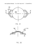 REFRACTIVE INTRAOCULAR IMPLANT LENS AND METHOD diagram and image