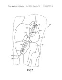 Prosthetic Ligament System for Knee Joint diagram and image