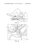 APPARATUSES AND TECHNIQUES FOR BIOACTIVE DRUG DELIVERY IN THE PROSTATE GLAND diagram and image