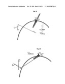 METHODS AND DEVICES FOR LAPAROSCOPIC SURGERY diagram and image