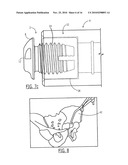 Pelvic Cable Solution diagram and image