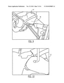 Pelvic Cable Solution diagram and image