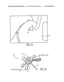 Pelvic Cable Solution diagram and image