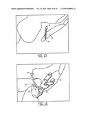 Pelvic Cable Solution diagram and image