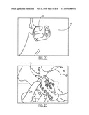 Pelvic Cable Solution diagram and image