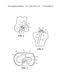 Patient-Specific Joint Arthroplasty Devices for Ligament Repair diagram and image