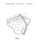 Patient-Specific Joint Arthroplasty Devices for Ligament Repair diagram and image