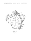 Patient-Specific Joint Arthroplasty Devices for Ligament Repair diagram and image