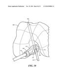 Patient-Specific Joint Arthroplasty Devices for Ligament Repair diagram and image
