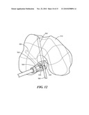 Patient-Specific Joint Arthroplasty Devices for Ligament Repair diagram and image