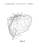 Patient-Specific Joint Arthroplasty Devices for Ligament Repair diagram and image