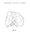 Patient-Specific Joint Arthroplasty Devices for Ligament Repair diagram and image