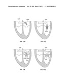 METHODS, SYSTEMS AND DEVICES FOR CARDIAC VALVE REPAIR diagram and image