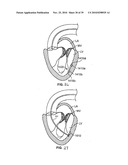 METHODS, SYSTEMS AND DEVICES FOR CARDIAC VALVE REPAIR diagram and image