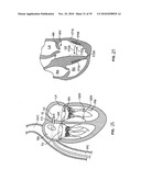 METHODS, SYSTEMS AND DEVICES FOR CARDIAC VALVE REPAIR diagram and image