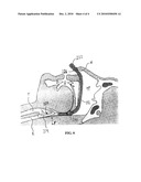 NASAL AIRWAY MANAGEMENT DEVICE WITH INFLATABLE SUPRAGLOTTIC LARYNGEAL CUFF diagram and image