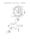 ULTRASONIC GUIDANCE OF SUBCUTANEOUS TUNNELING diagram and image