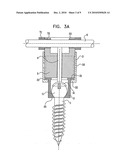 MULTIDIRECTIONAL BONE FIXATION ASSEMBLY diagram and image