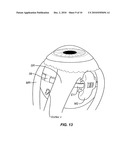 SCLERAL BUCKLES FOR SUTURELESS RETINAL DETACHMENT SURGERY diagram and image