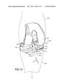 Knee Prosthesis Assembly With Ligament Link diagram and image