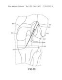 Knee Prosthesis Assembly With Ligament Link diagram and image