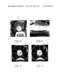  METHOD FOR TRACKING 3D ANATOMICAL AND PATHOLOGICAL CHANGES IN TUBULAR-SHAPED ANATOMICAL STRUCTURES diagram and image