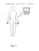 Systems and methods for lumbar cerebrospinal fluid access and treatment diagram and image