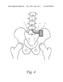 Systems and methods for lumbar cerebrospinal fluid access and treatment diagram and image