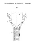 FLEXIBLE CANNULA DEVICES AND METHODS diagram and image