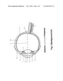 A METHOD AND A SYSTEM FOR LASER PHOTOABLATION WITHIN A LENS diagram and image