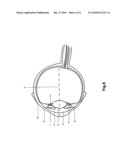 A METHOD AND A SYSTEM FOR LASER PHOTOABLATION WITHIN A LENS diagram and image