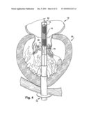 APPARATUS AND METHOD FOR REPLACING A DISEASED CARDIAC VALVE diagram and image