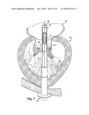 APPARATUS AND METHOD FOR REPLACING A DISEASED CARDIAC VALVE diagram and image