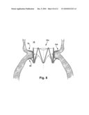 APPARATUS AND METHOD FOR REPLACING A DISEASED CARDIAC VALVE diagram and image