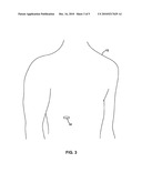 DISSOLVABLE PHARMACEUTICAL IMPLANT diagram and image