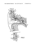 IMPLANTABLE AUDITORY STIMULATION SYSTEM AND METHOD WITH OFFSET IMPLANTED MICROPHONES diagram and image