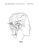 IMPLANTABLE AUDITORY STIMULATION SYSTEM AND METHOD WITH OFFSET IMPLANTED MICROPHONES diagram and image