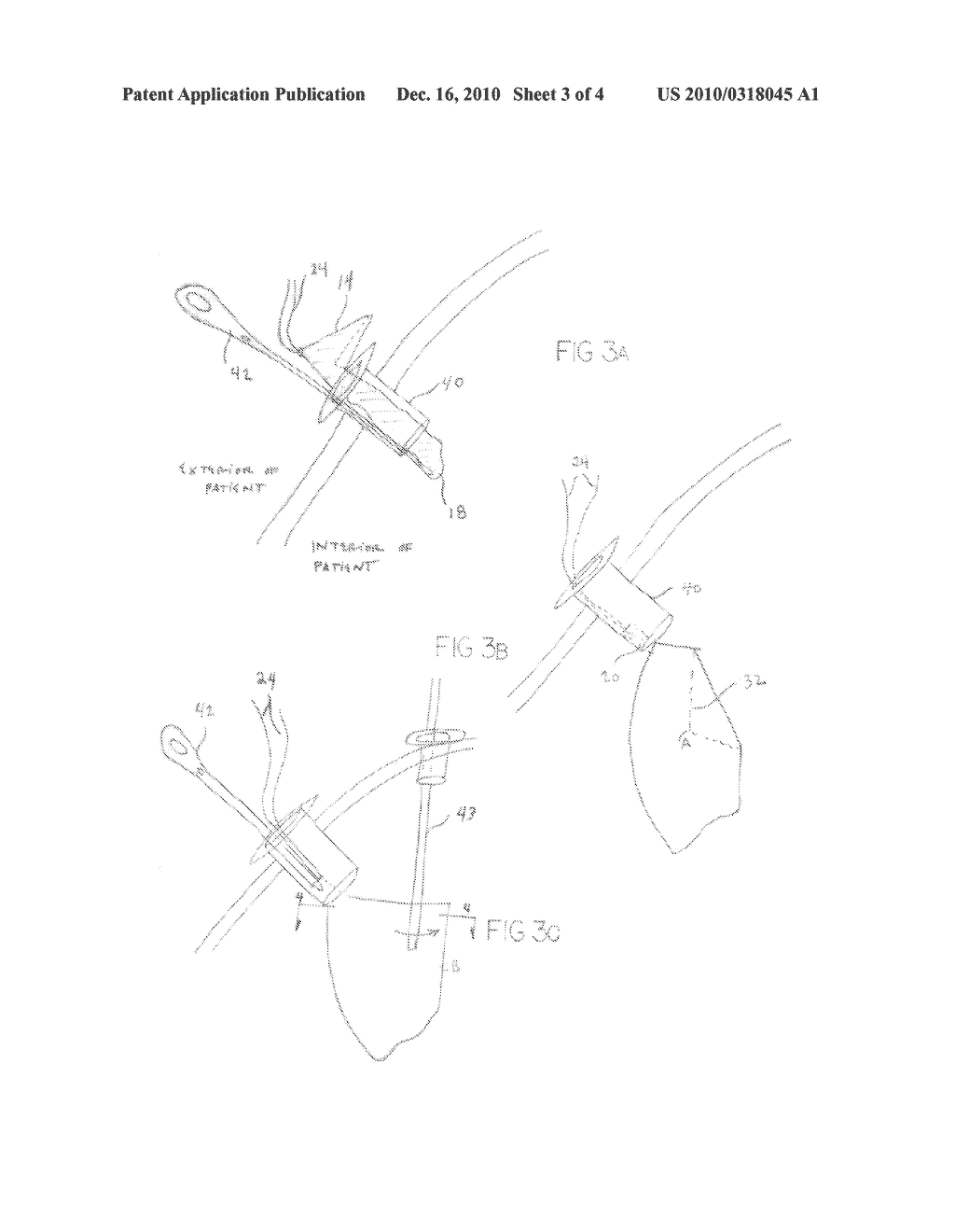 TISSUE SPECIMEN RETRIEVAL BAG, METHOD FOR RETRIEVING TISSUE - diagram, schematic, and image 04