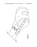 METHOD AND APPARATUS FOR TREATING PERIPROSTHETIC FRACTURES OF THE DISTAL FEMUR diagram and image