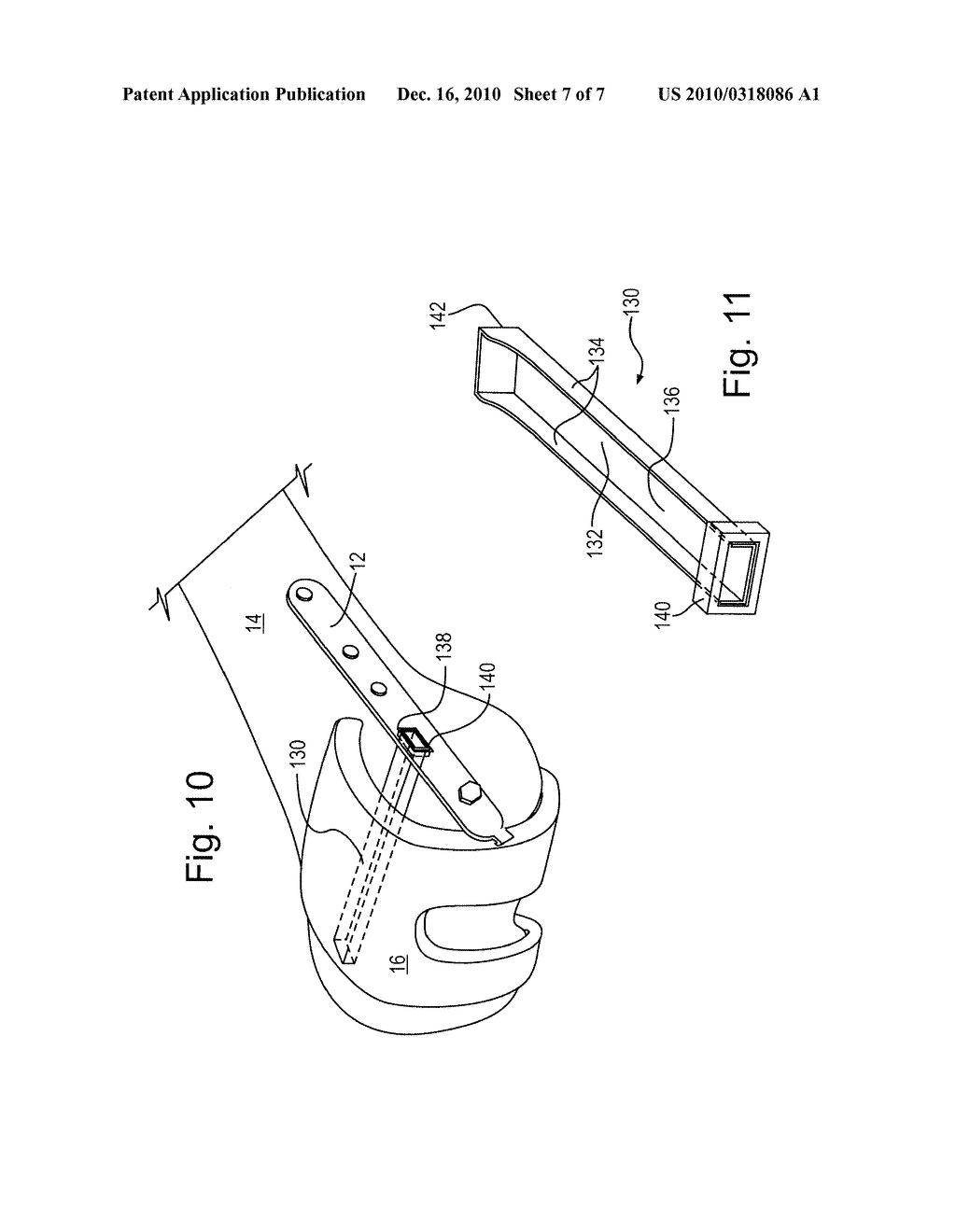 METHOD AND APPARATUS FOR TREATING PERIPROSTHETIC FRACTURES OF THE DISTAL FEMUR - diagram, schematic, and image 08