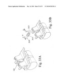 DEVICES AND METHODS FOR INTER-VERTEBRAL ORTHOPEDIC DEVICE PLACEMENT diagram and image